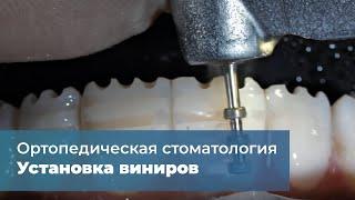 Клиническая история: установка виниров