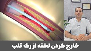 خارج کردن لخته خون از رگ قلب