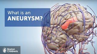 Brain Aneurysms | Boston Children's Hospital