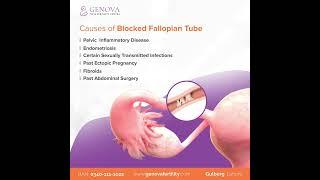 Causes of a blocked Fallopian Tube - Genova IVF