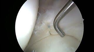 Sutura de Menisc / Meniscal Suture - DR. AHMAD ALQADI