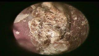 Blocked Earwax Removal | Doctor Anh