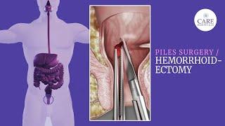 Your Ultimate Guide to Piles Surgery Hemorrhoidectomy