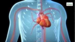 Angioplasty Procedure Animation Video.