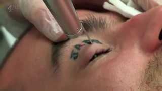 Tattoo Removal Laser Treatment and its results