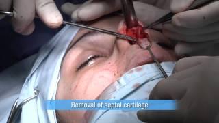 Nose Job, Rhinoplasty, Sydney Australia Plastic Surgeon Dr Barnouti