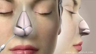 Rhinoplasty (Nose Job) Video Animation - Guncel Ozturk, MD - #DRGO