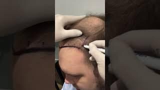 Hair Transplant in Turkey | Hair Transplant Process 5000 grafts  #hairtransplantturkey