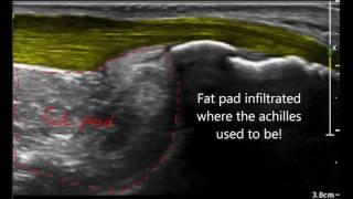 Haglund deformity versus haglund syndrome