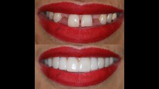 Houston Cosmetic Dentist...Cosmetic options from A to Z....$$$$$ to $...We can fit your Budget!