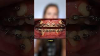 Si tienes los dientes muy APIÑADOS, este time lapse de brackets te va a INTERESAR