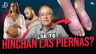Se Te HINCHAN LAS PIERNAS ? Podrías Tener Esto, Oswaldo Restrepo RSC