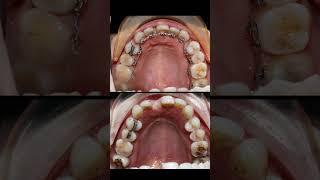 Niềng răng thưa mắc cài mặt lưỡi - Lingual braces