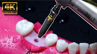 AWESOME dental implant process in 4K