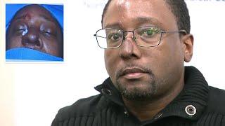 Long Island man who lost nose in attack gets reconstructive surgery: 'I feel like before'