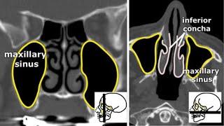 Компьютерная томография околоносовых пазух: почему важно знать анатомию, как не пропустить патологию