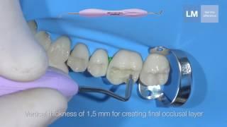 LM-Arte™ Posterior Misura - Fill evenly