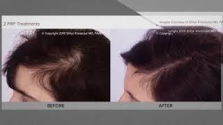 PRP for hair loss