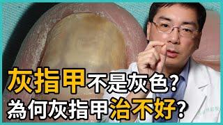 灰指甲不是灰色的嗎？還有其他顏色嗎？為何灰指甲一直治不好？讓皮膚科林政賢醫師一一點破治療灰指甲的NG行為吧！