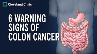 6 Warning Signs of Colon Cancer