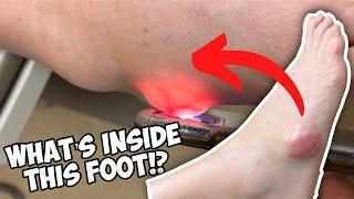 Look what was in this foot?!  Dr. Nick Campitelli