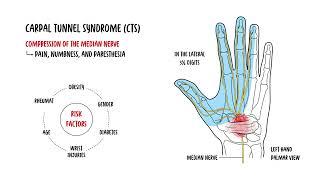 Understanding Carpal Tunnel Syndrome and Carpal Tunnel Anatomy