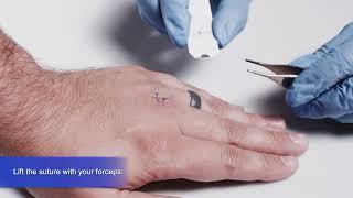 How-To: The Bionix SutureOut® Suture Removal Tool