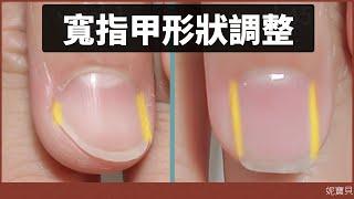 甲型調整｜寬指甲形狀調整｜扇形指甲 甲床萎縮 摳咬指甲 問題指甲矯正計畫