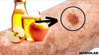 Apple Cider Vinegar Will Remove Age Skin Spots if You Do This...