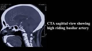SCA-Basilar aneurysm: Microsurgical clipping