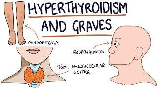 Understanding Hyperthyroidism and Graves Disease