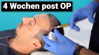 PRP Therapie 4 Wochen nach der Haartransplantation in Deutschland | Update und Erfahrung