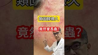 #皮膚科醫師 告訴你類固醇擦久竟然會長蟲#吳仁欽皮膚科診所 #酒糟性皮膚炎 #舒立達 #蠕型蟎蟲 #痘痘 #驗蟲 #過敏 #紅腫 #皮膚搔癢 #類固醇 #消炎止癢 #微血管擴張  #乳液 #乳霜