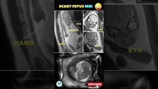 Baby MRI | Fetal scan | Pregnancy week by week #pregnancy #mri #sonography