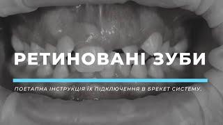 Ретиновані зуби: поетапна інструкція їх підключення в брекет систему.