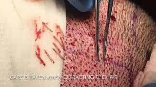 Follicular Unit Extraction (FUE) Hair Transplant by Dr. Thomas Nakatsui