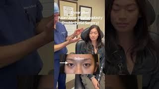 Double Eyelid Surgery by Dr. Taban