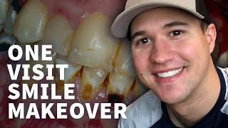 Same Day Smile Makeover - Veneers & Crowns