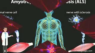 Doctor explains Amyotrophic lateral sclerosis (ALS)