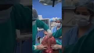 Derotation of Sigmoid Volvulus | Dr Subhadip Sarkar