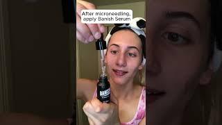 This is why microneedling and vitamin C are great for your acne scars #acnescars #acne #skincare