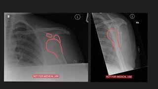 Shoulder dislocation