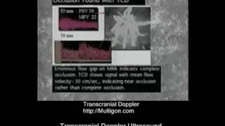 Transcranial Doppler Ultrasound Case Studies Part 2.mp4