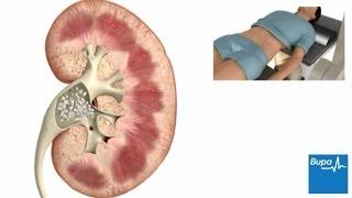 How extracorporeal shockwave lithotripsy is used to treat kidney stones | Bupa Health