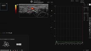 LOGIQ P9 Tutorials: Color Quantification