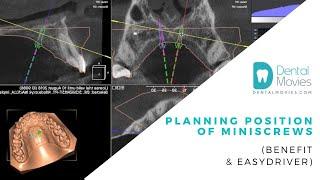 PLANNING POSITION of MINISCREWS   (BENEFIT & EASYDRIVER)