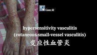 hypersensitivity vasculitis, cutaneous small vessel vasculitis CSVV, 变应性血管炎