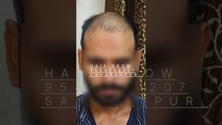 4 MONTH RESULT DHI HAIR TRANSPLANT IN SAHARANPUR #saharanpur #shorts #youtube #hairtransplant