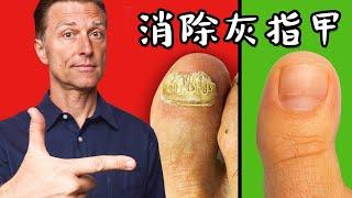 消除灰指甲真菌的方法,自然療法,柏格醫生 Dr Berg