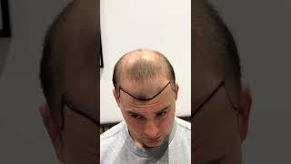 Hair Transplant in Turey | Hair Transplant Turkey Cost | Hair Transplant Before and After Operation